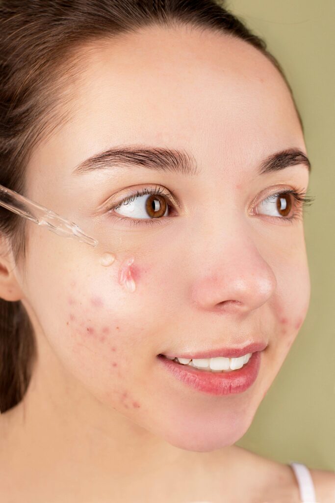 A smiling woman applying a treatment serum to her face to treat hormonal acne on her chin and jawline.